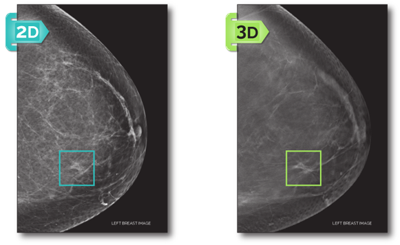 2d and 3d mammogram - center for diagnostic imaging - miami florida