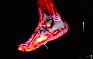PET MRI of Foot